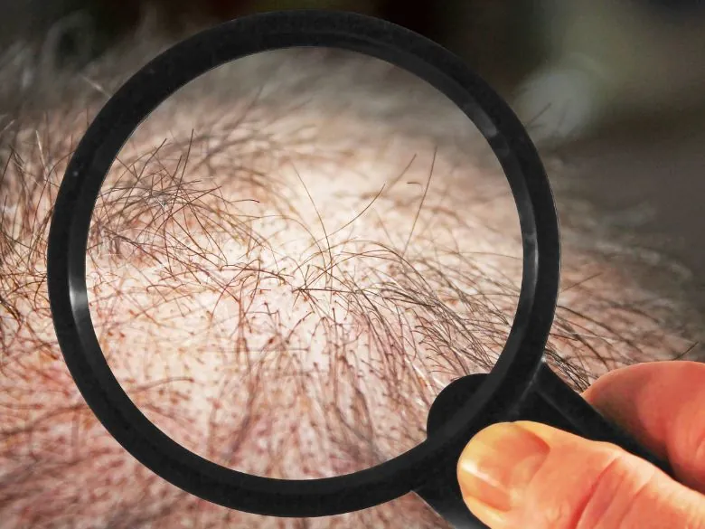 Introbild: Spirulina gegen Haarausfall Vergrößerte Kopfhaut mit Haarfollikeln unter einer Lupe, symbolisiert den möglichen positiven Einfluss von Spirulina bei Haarausfall.